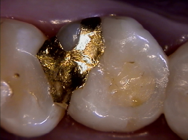 수복물과 교합 (gold inlay)